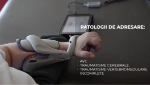 Orteza care ajută pacienții să reînvețe să își miște mâna paralizată în urma AVC sau a unor traumatisme ale coloanei vertebrale